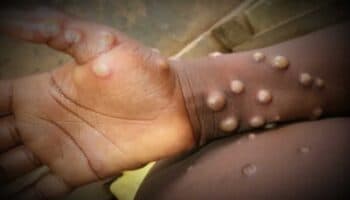 Confirman 49 caos de viruela símica en México