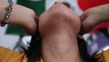 Esta es la historia de Ayyselet, víctima de intento de feminicidio que recibió 27 puñaladas