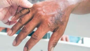 La lepra aún no se ha erradicado en México, pero se puede evitar su contagio: UNAM