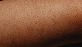 ¿Que es la queratosis pilaris? #Niñonautas con Kirén Miret