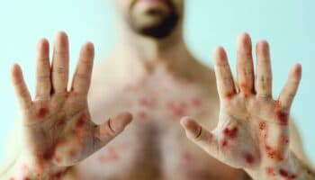 Secretaría de Salud emite estas recomendaciones sobre el mpox