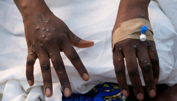 Mpox: OMS da luz verde a la vacuna de Bavarian Nordic