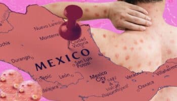 México en top 10 de países más afectados por Mpox, según DGE