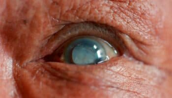 'Ver por México', conoce el programa de cirugías gratuitas de cataratas