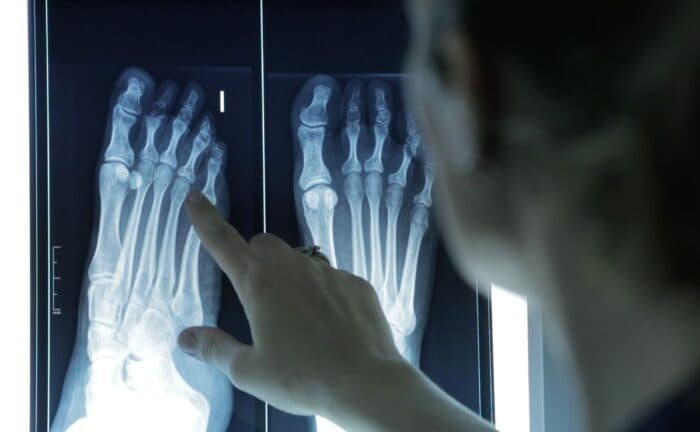 Podólogos: 60% de los adultos padece deformidades en los dedos de los pies